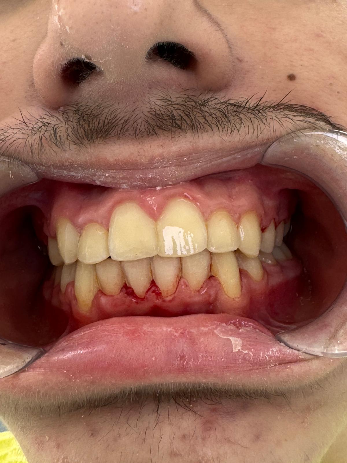 Reconstructie dantura prin implant dentar Craiova rezultate finale
