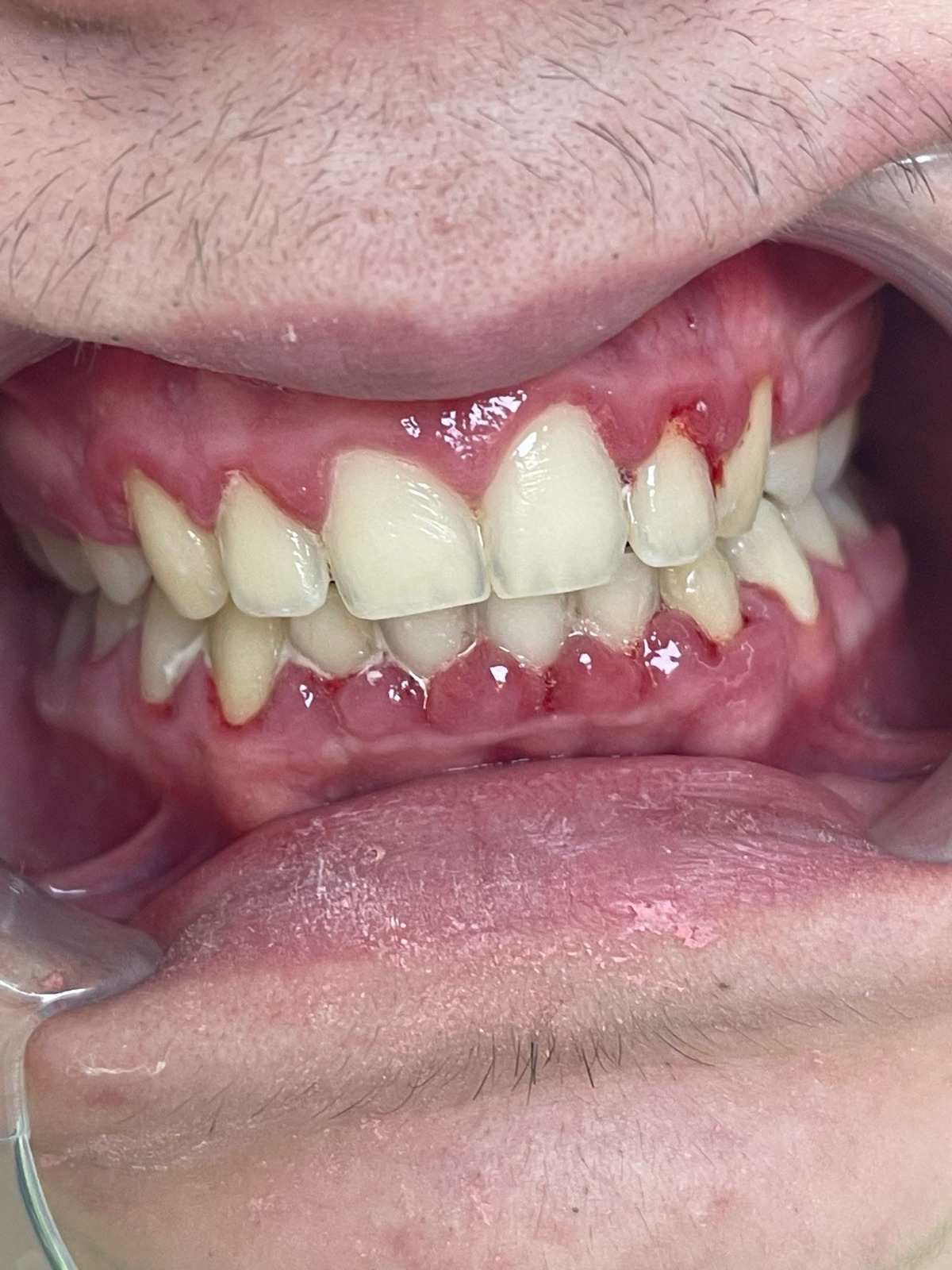 Rezultat estetic dupa tratament dentar Diadent Craiova