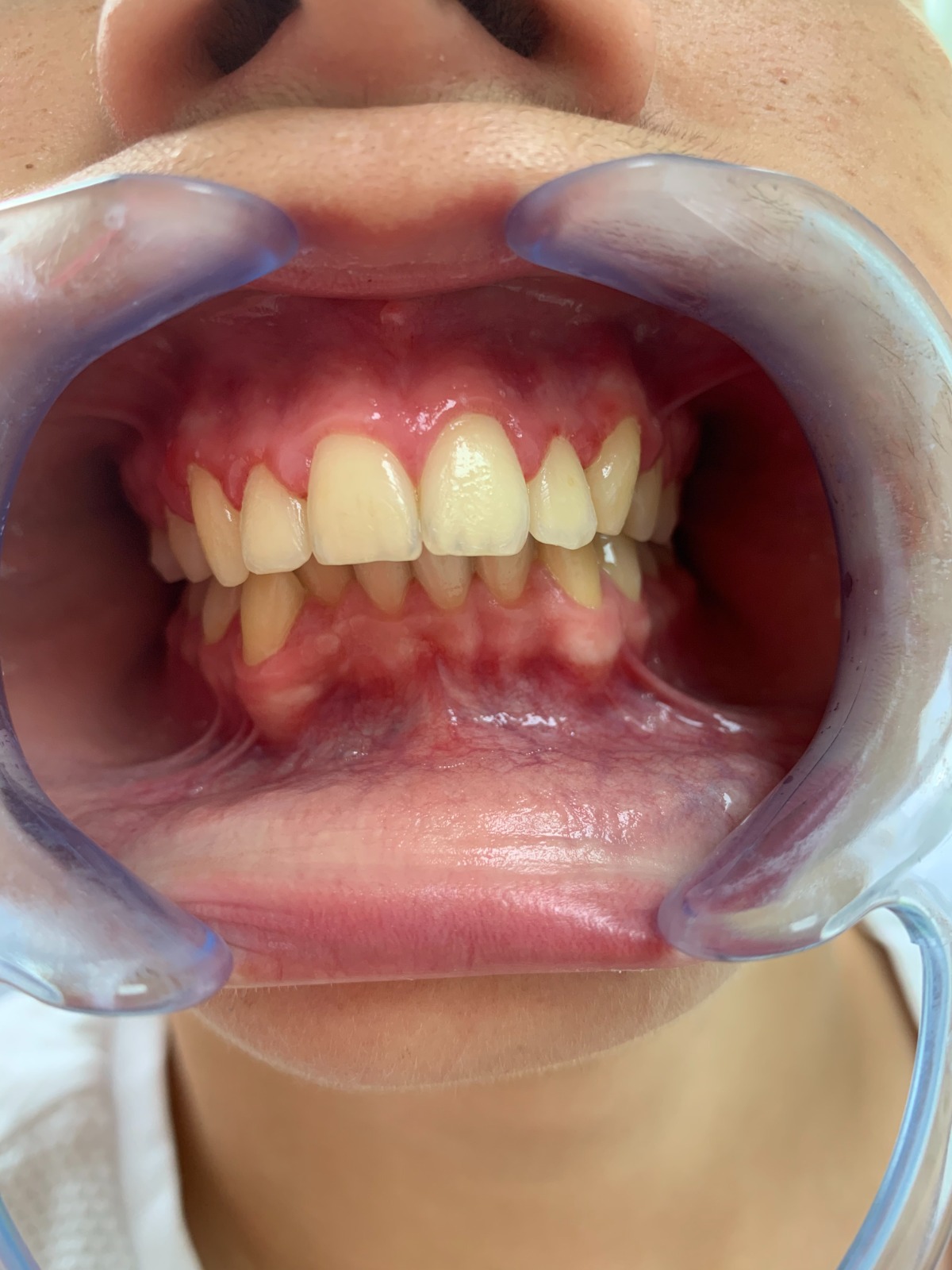Aspect initial inainte de tratament dentar Diadent Craiova