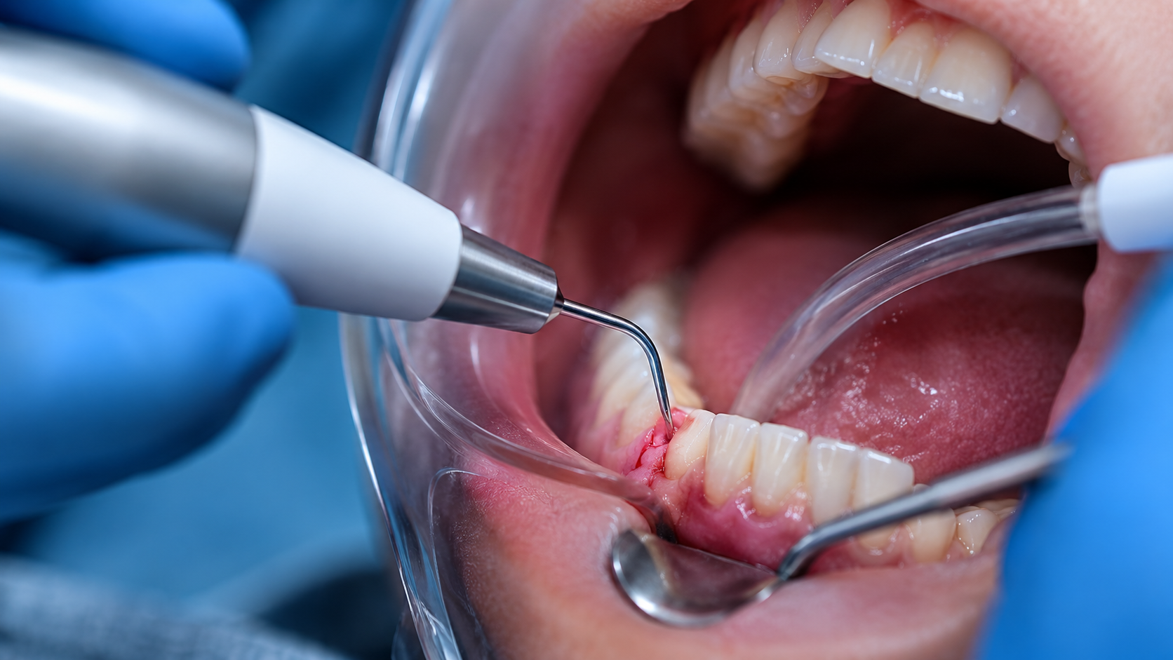 Pret implant dentar, chirurgie orala si extractie masea minte Craiova