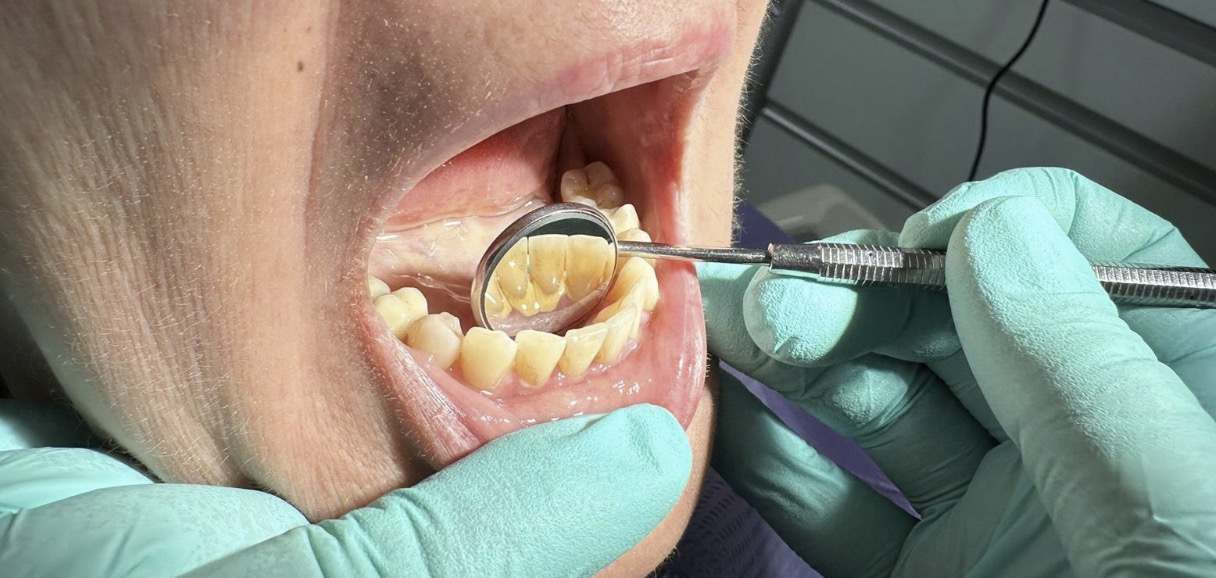 Probleme estetice si dantura ingalbenita inainte de dentist